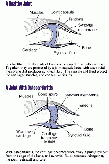 Osteoarthritis joint abnormalities
